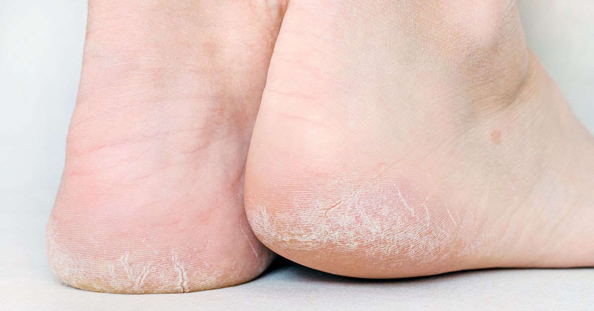 Eeltvoeten, met eelt op de hakken.