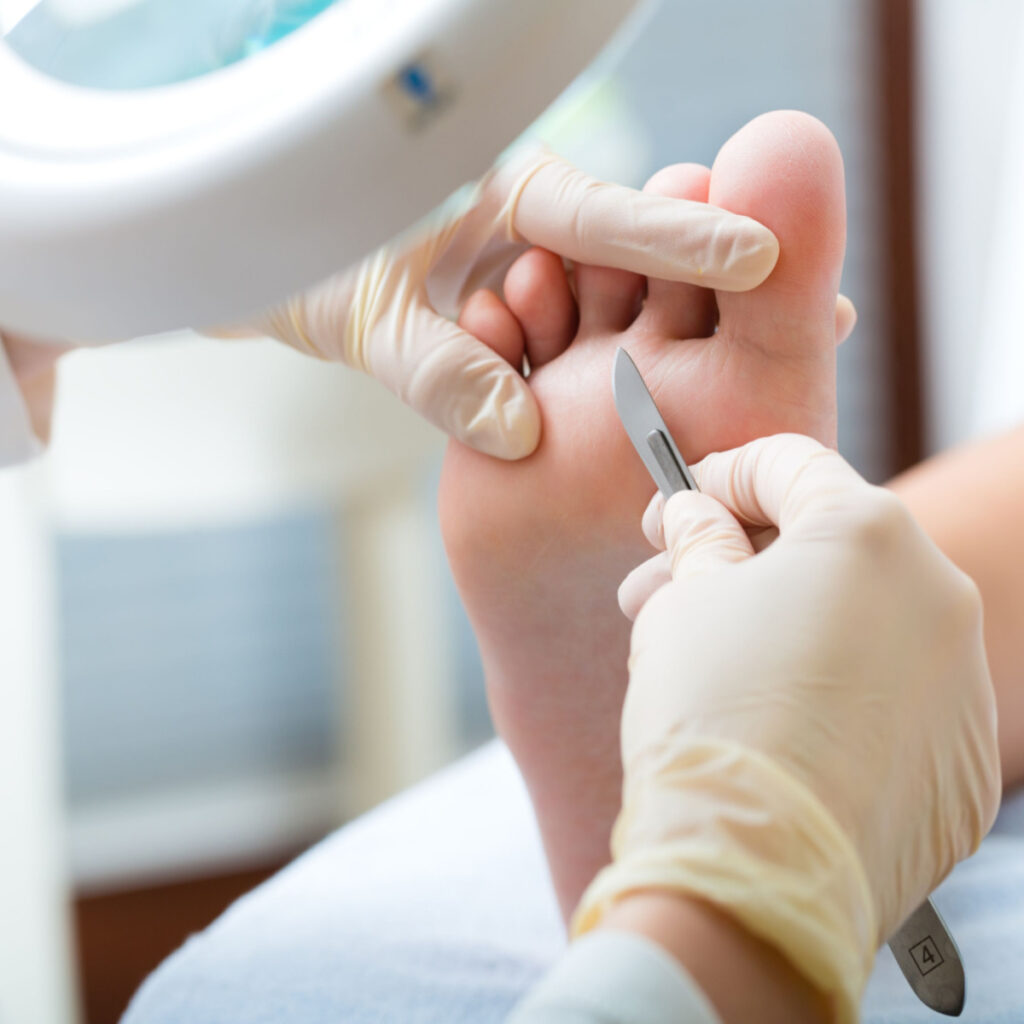 Hier wordt het eelt onder de voetzool verwijderd d.m.v. een chirurgenmesje.